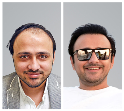 Hyderabad hair transplant clinic